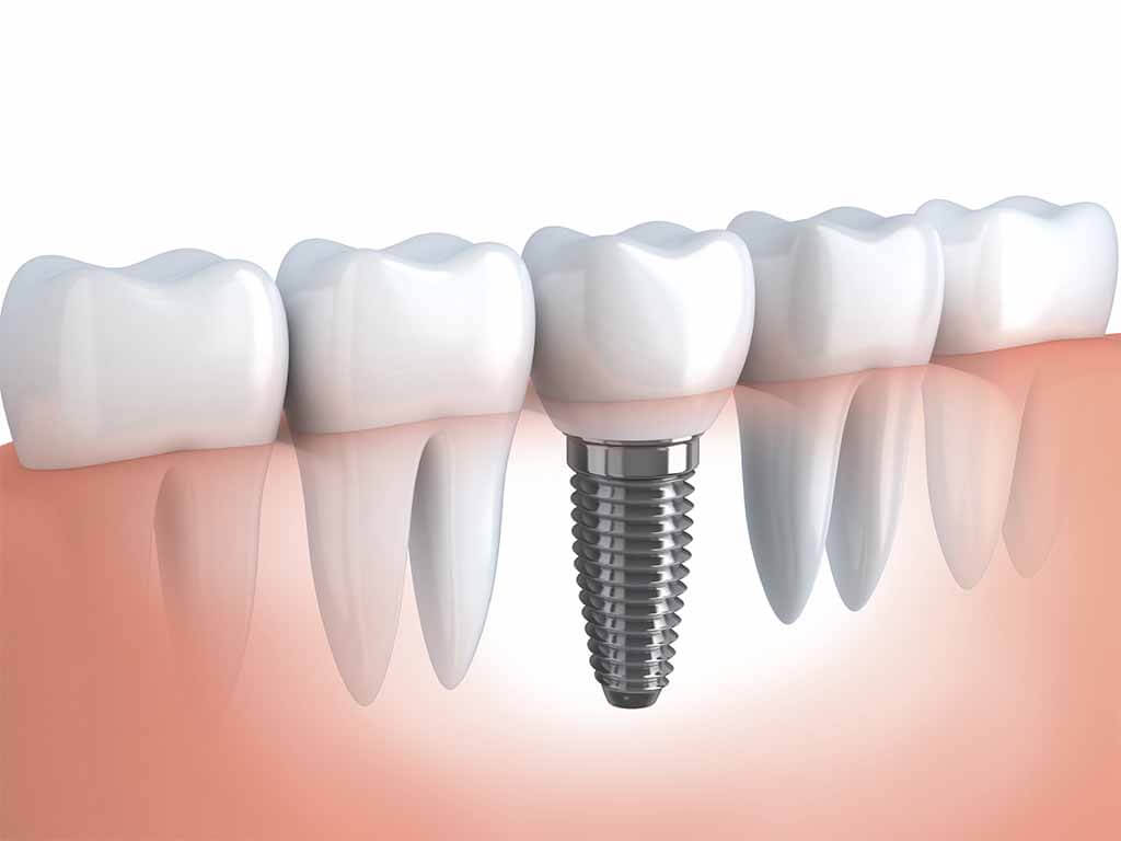 Implantes dentales, ¿qué planes de salud los cubren?