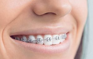 Ortodoncia, Implantes, Perno y Corona, Odontología avanzada: ¿Qué obras sociales son mejores? ¿Cuáles son planes médicos con mejor cobertura odontológica?