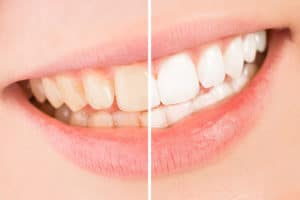 Prepagas que cubren tratamientos de blanqueamiento dental