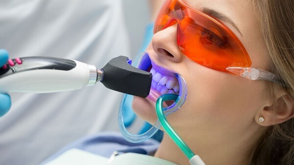 Opciones de tratamientos para aclarar los dientes: siempre es mejor en un consultorio
